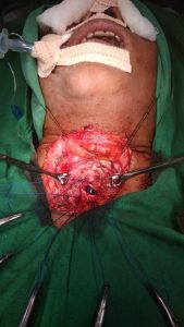 Operating a case of tracheal stenosis or removal of FB from RMB