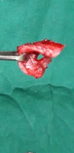 Operating a case of tracheal stenosis or removal of FB from RMB