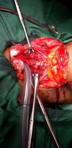 Operating a case of tracheal stenosis or removal of FB from RMB