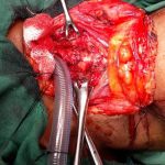 Operating a case of tracheal stenosis or removal of FB from RMB